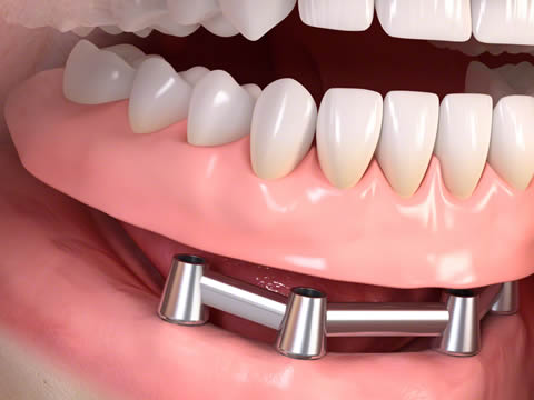 Implant Stabilised Dentures