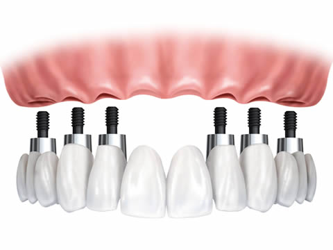 Implants su[[porting full bridge of teeth