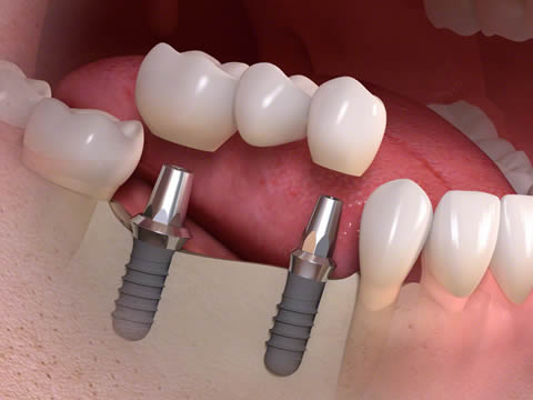 Multiple Dental Implants